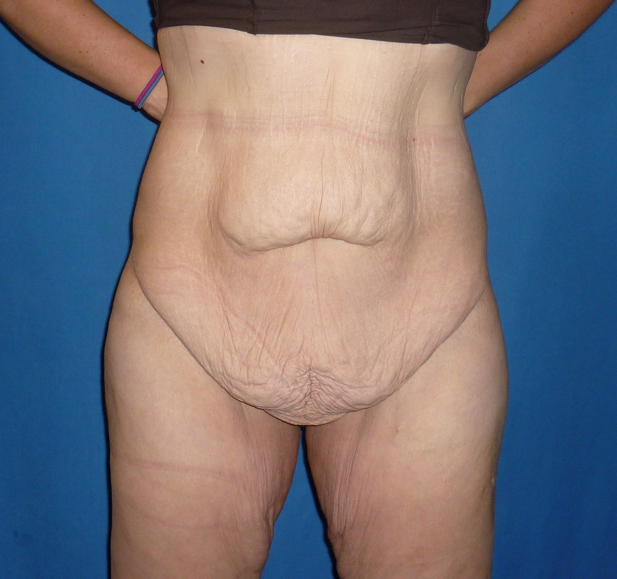 Tummy Tuck Liposuction Denver.